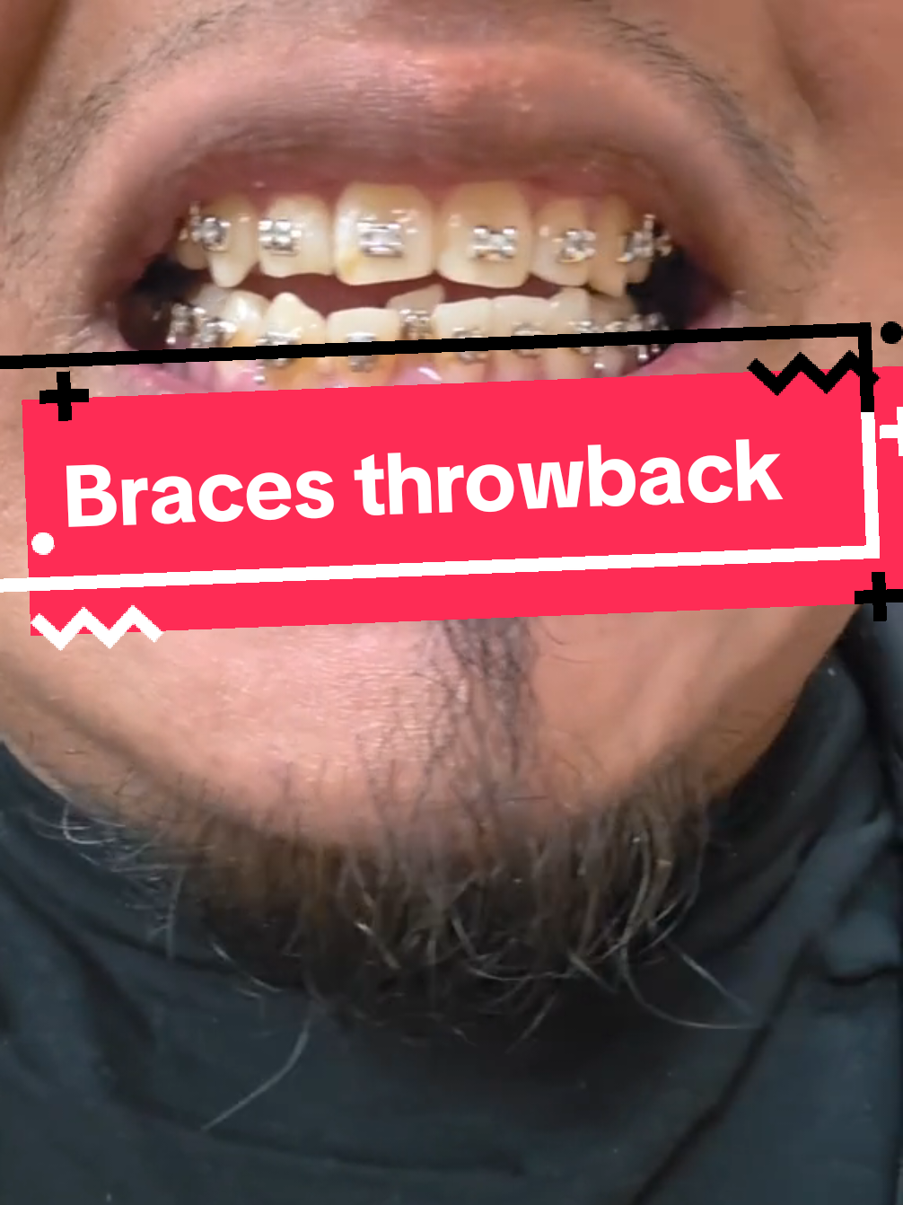 @str8braces